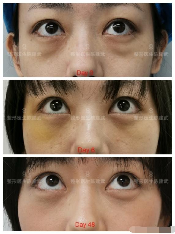 女人眼袋整容失败,30岁后女人去眼袋微整效果图