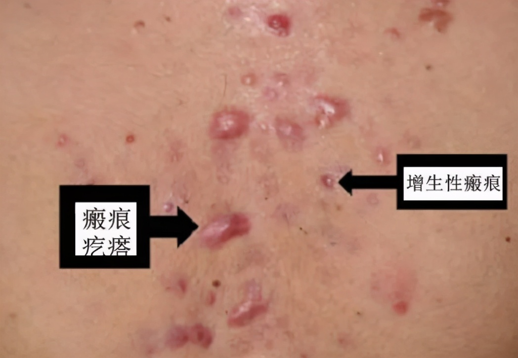 疮疤怎么祛疤,疮疤去除