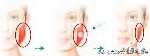 爱美人士打瘦脸针,爱美除皱针效果怎么样