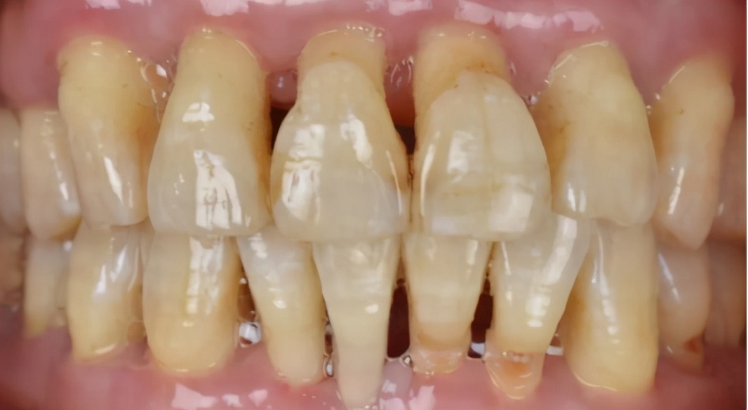 18岁女孩牙齿磨了,门牙是烤瓷牙可以矫正牙齿吗