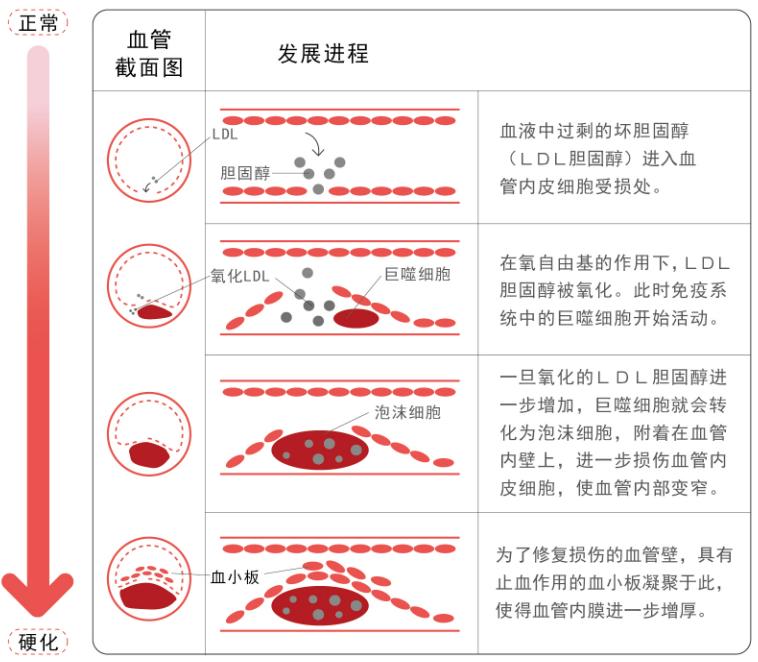 动脉粥样硬化有哪些危险,动脉粥样硬化会导致脑血栓吗