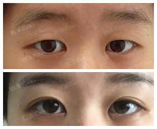 开内眼角失败留疤了怎么办,开外眼角恢复期间会有紧绷感么