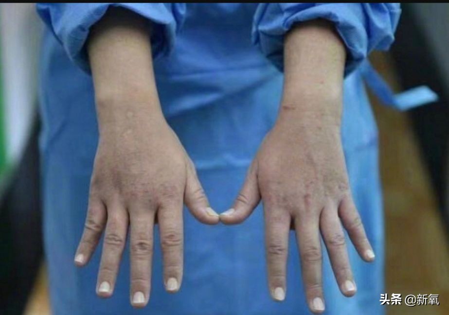 戴口罩久了皮肤屏障会受损吗,戴口罩戴久了鼻子不舒服