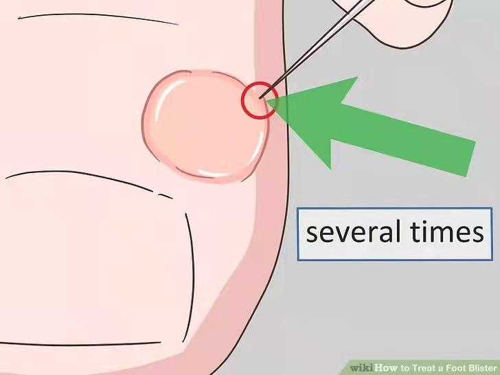 跑完步脚底起水泡如何处理,跑完步手掌起了好多小水泡