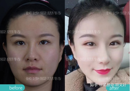 哪些人群不适合做热玛吉?