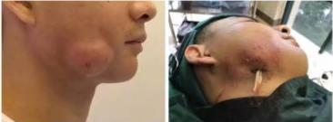 女子智齿烂脸,智齿发炎的真实案例