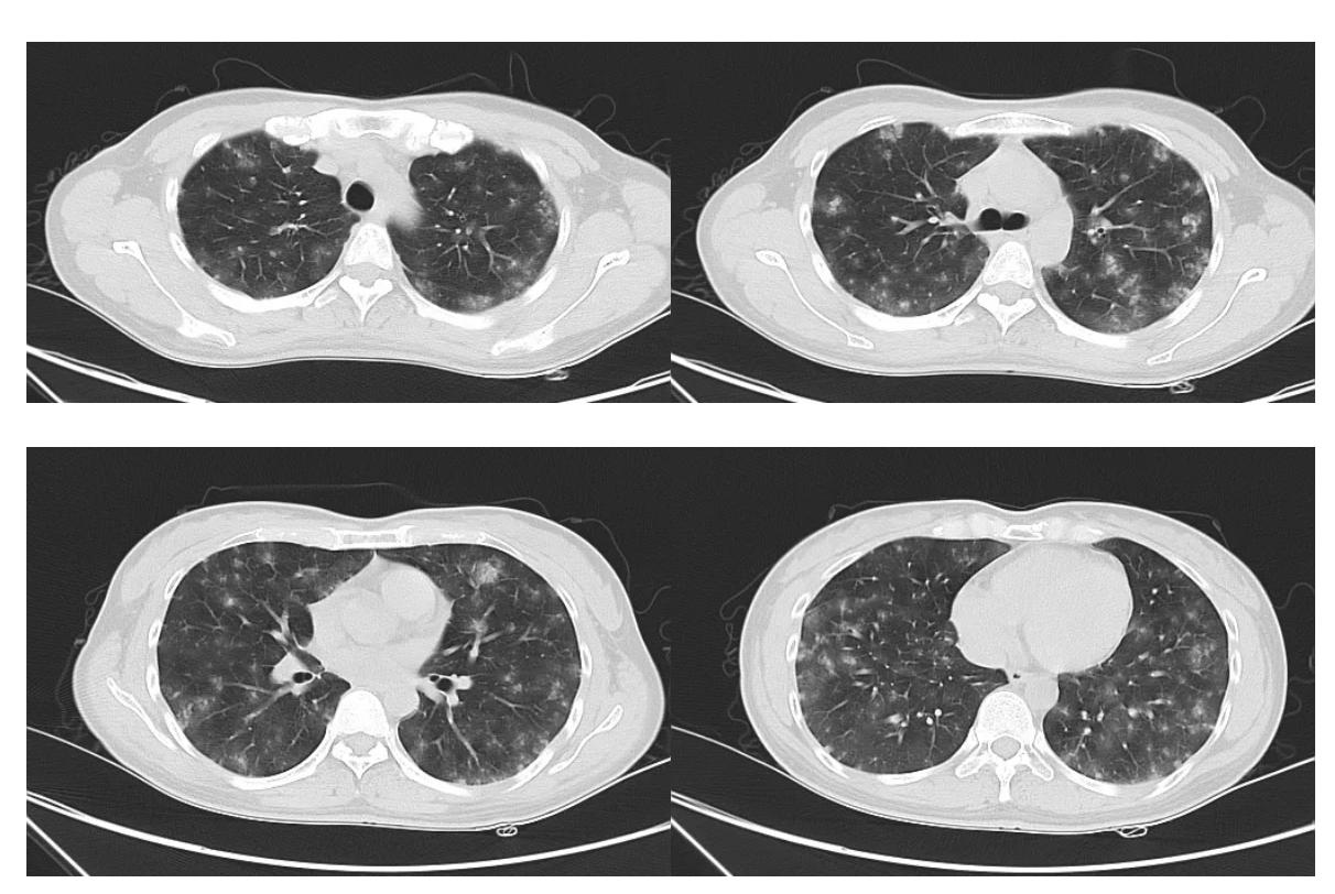 弥漫性肺泡出血能治好吗,弥漫性肺泡出血能活多久