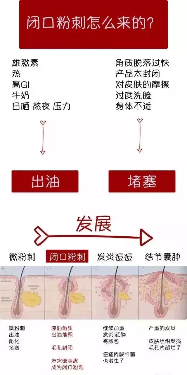 闭口性粉刺怎么去除,闭口性粉刺怎么去除最快