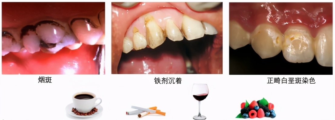 一口黄牙怎么办？10年牙科医生教你怎么拥有一口亮白美牙