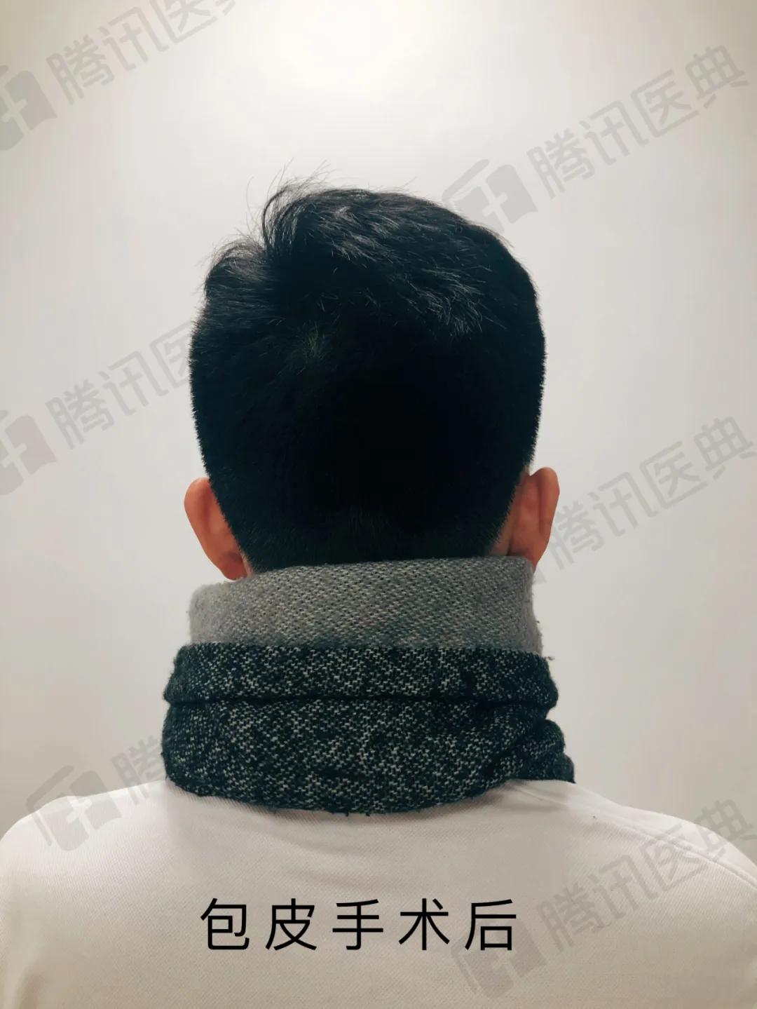 割包皮有可能割短吗,割包皮能治疗好疱疹吗