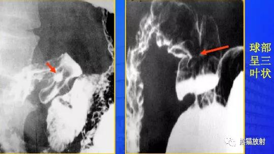 十二指肠球部溃疡解剖位置,十二指肠球部溃疡x线表现