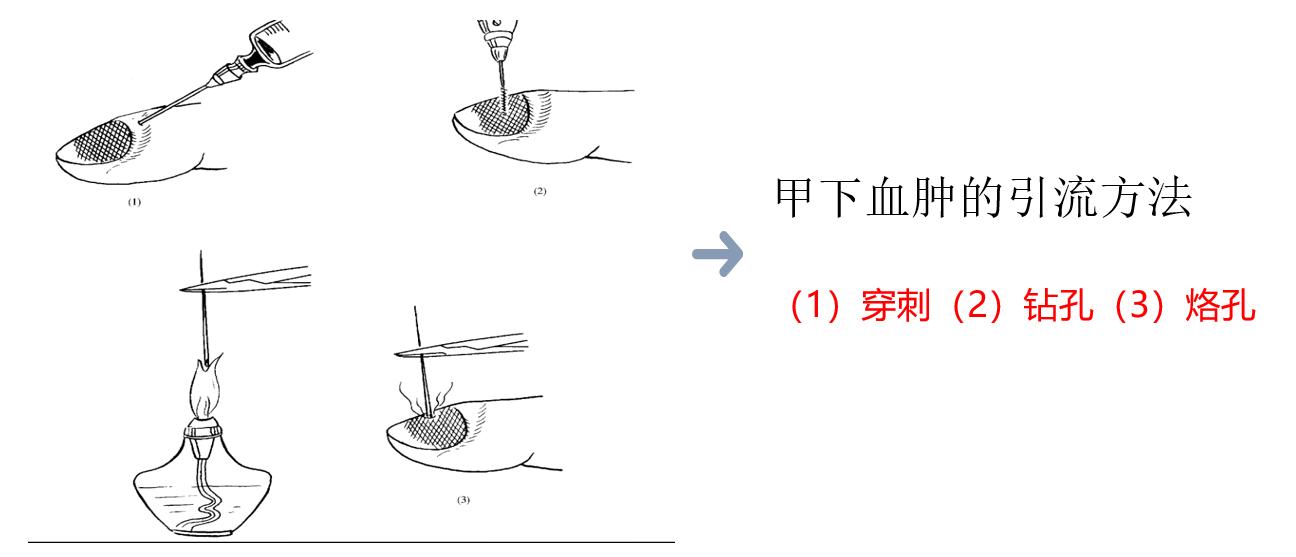 甲下积血怎么处理,甲下积血不排血会胀痛吗
