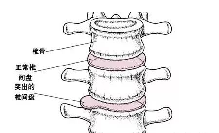 鑵版闂寸洏绐佸嚭鍗佸ぇ绂佸繉,鑵版闂寸洏绐佸嚭娌荤枟鏂规硶