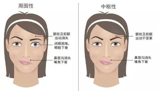 面瘫后遗症5年能治好吗怎么治,面瘫后遗症还能治好吗