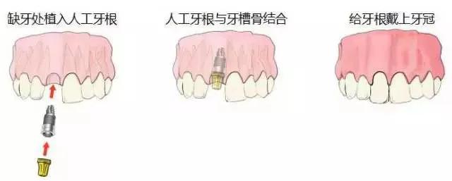 雅悦齿科烤瓷牙视频,明星都做了全烤瓷牙吗