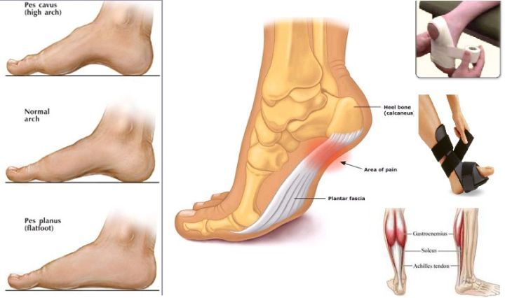 一边扁平足一边弓足如何矫正,扁平足足弓酸痛怎么治疗