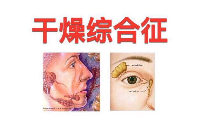 中药是如何治疗干燥综合征？