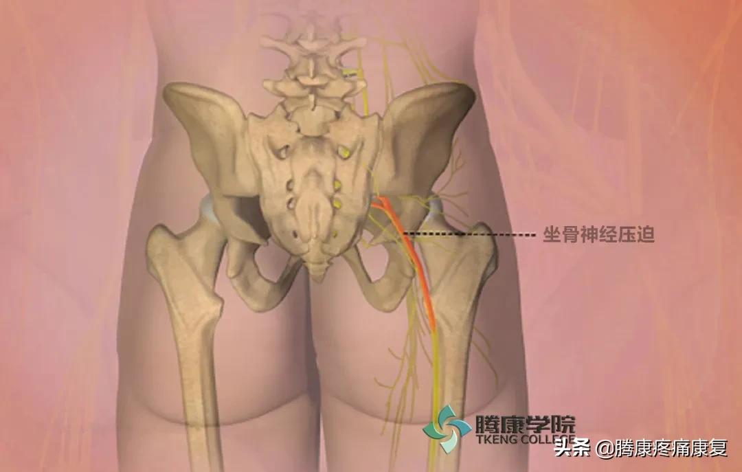坐骨神经痛什么药能除根,坐骨神经痛的原因与诊疗