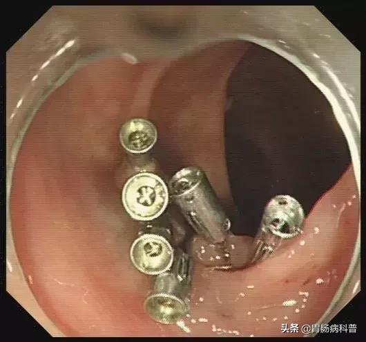 只要是肠息肉都要割掉吗,医生肠息肉切除后怎么处理伤口