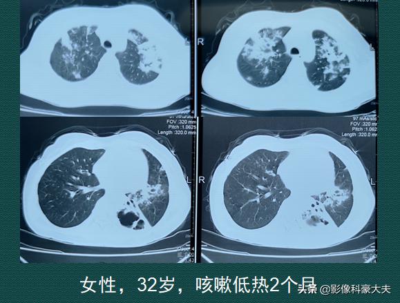 32岁宝妈发烧咳血肺空洞,糖尿病不吃药,风险有多大?