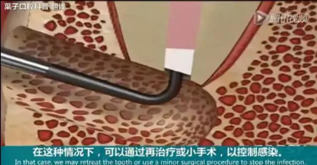 上牙龈上火突出一个鼓包,牙龈肿胀鼓包上火了吗