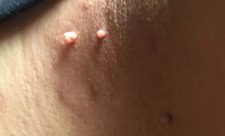 身上长小肉粒可以抠掉吗?小肉粒“偏爱”这些人