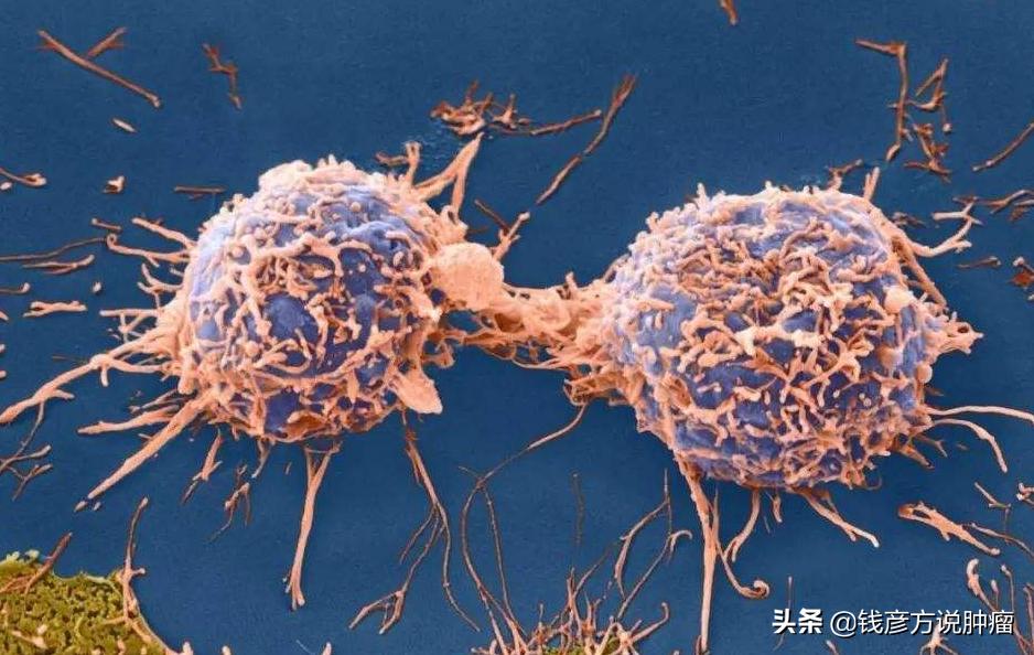 癌症晚期已转移扩散吃中药调理,结肠癌晚期肺转移吃中药有用吗