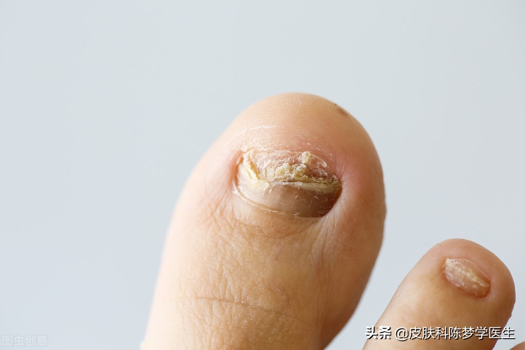 灰指甲用什么外用药好,灰指甲可以用的中医药膏