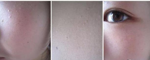 手动去脂肪粒工具,去脂肪粒神器排行榜