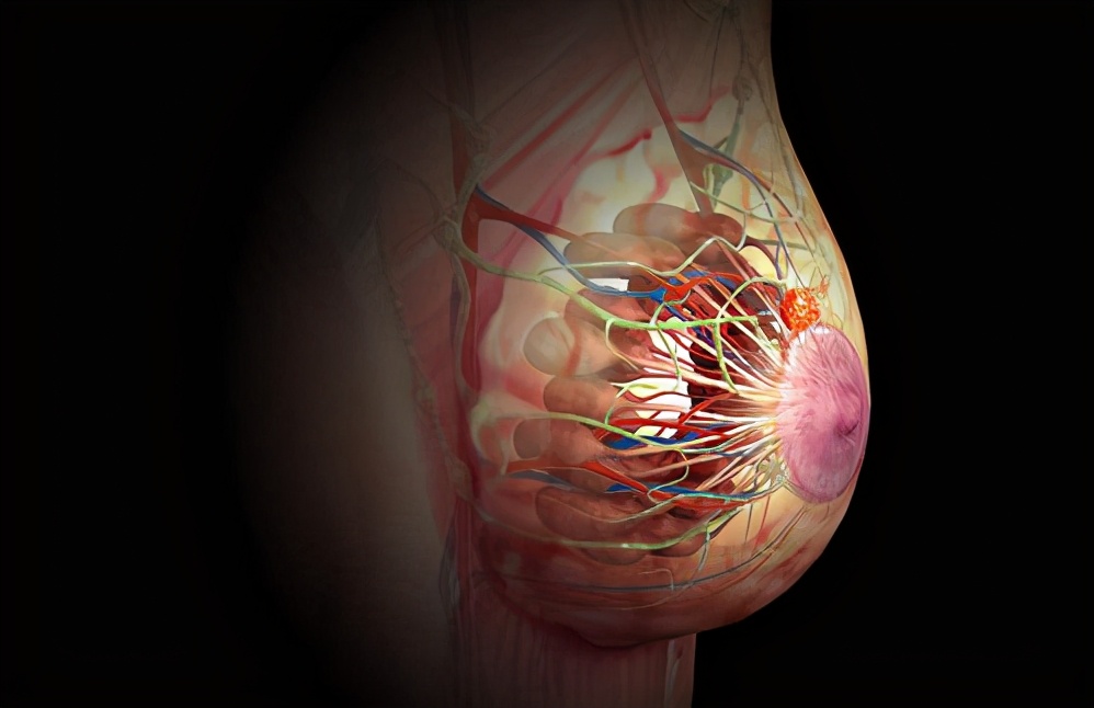 乳腺癌半个乳房都硬硬的,乳房硬块不痛是乳腺癌吗