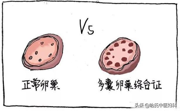 多囊卵巢综合症引起闭经怎么治疗,多囊卵巢综合症闭经了怎么办