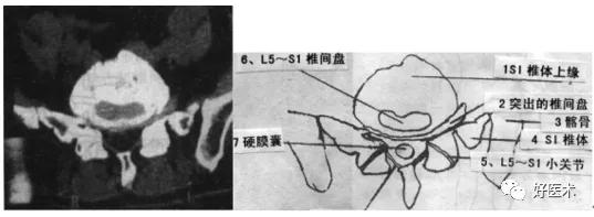腰部ct需要注意事项,做腰部ct需要注意的事项