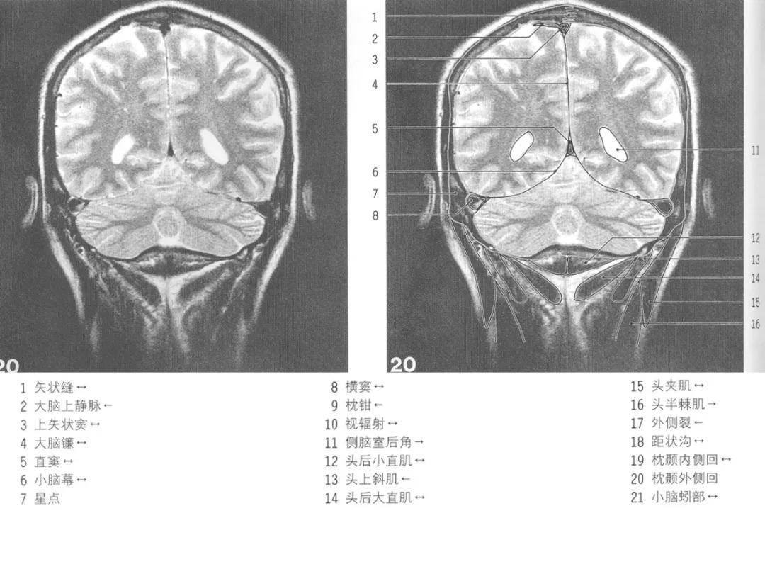 颅脑冠状状切面解剖图,颅脑mr解剖结构图