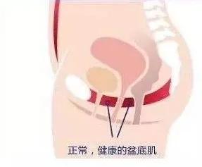 剖腹产能避免分娩疼痛吗,剖腹产能避免盆底肌松弛吗