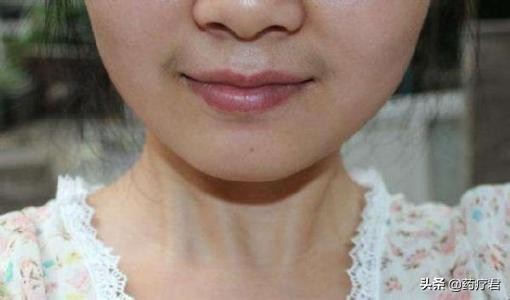 女性嘴唇长胡子怎么彻底去除,女生嘴唇为何长胡子