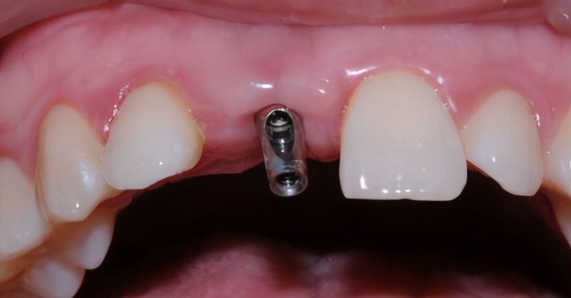 口腔卫生不好的危害,种植体周围炎治疗原则及方法