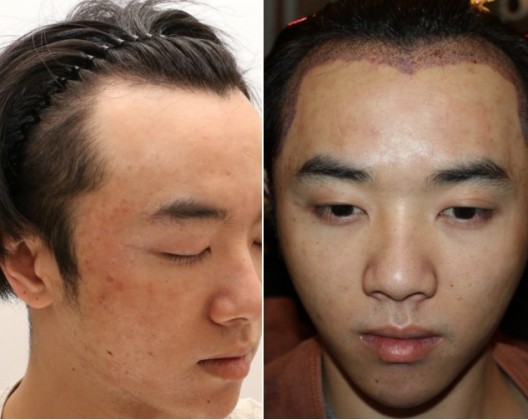 华晨宇植发的医院是哪里,华晨宇植发图片是真的吗