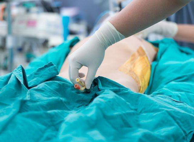 导尿管小便引流不出来怎么办,尿管引流不畅时该如何处理