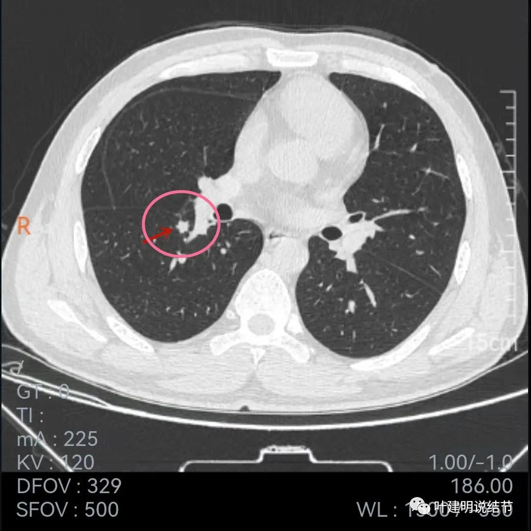 问诊分析:存在了4年的实性结节会不会是肺癌?