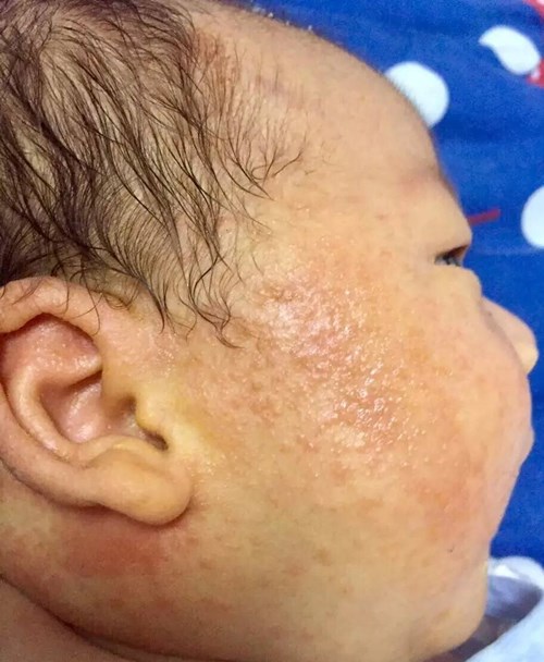 宝宝小疙瘩,宝宝小疙瘩是什么样的