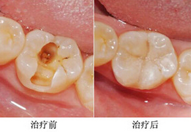 补牙是把牙洞都填平了吗,为啥补牙要把小洞变大