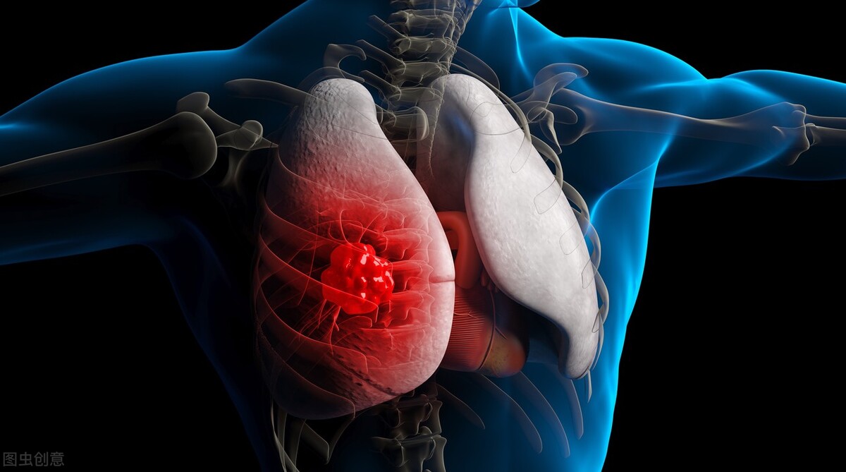 肺癌骨转移患者的曲折求医之路，中药调理，补气养阴、止咳解毒