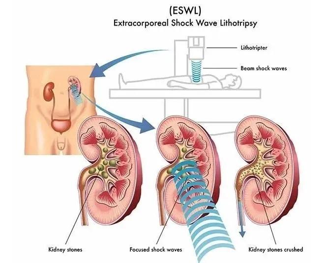 保守治疗结石的最好方法,胆囊泥沙结石到底需要不需要开刀