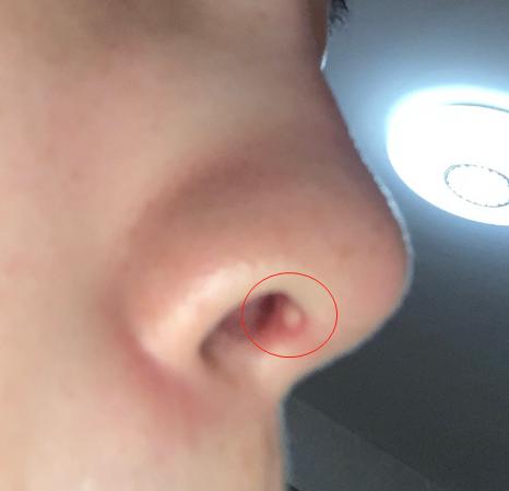 鼻子整形后鼻梁骨增生,鼻子整形增生会疼吗