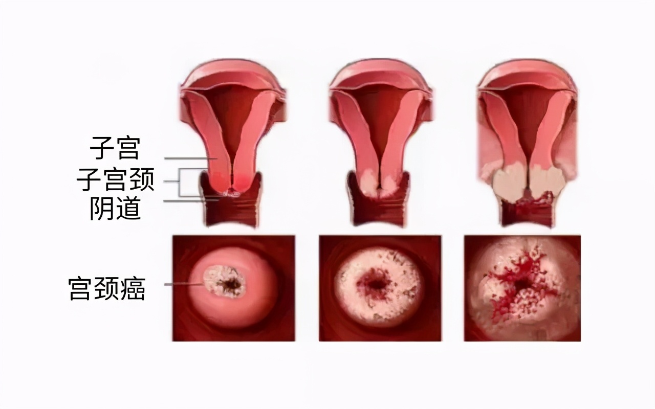 深圳癌症发病率最高的城市,深圳癌症多少例