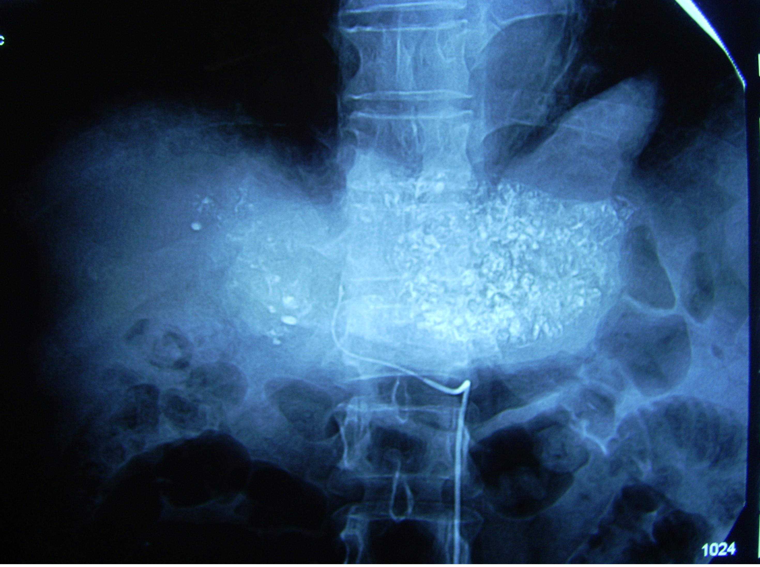 肝癌晚期保守治疗的成功案例,肝癌晚期治疗存活2年以上的案例