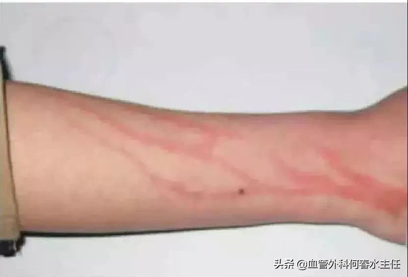 静脉曲张腿脚不好？治疗有“门路”