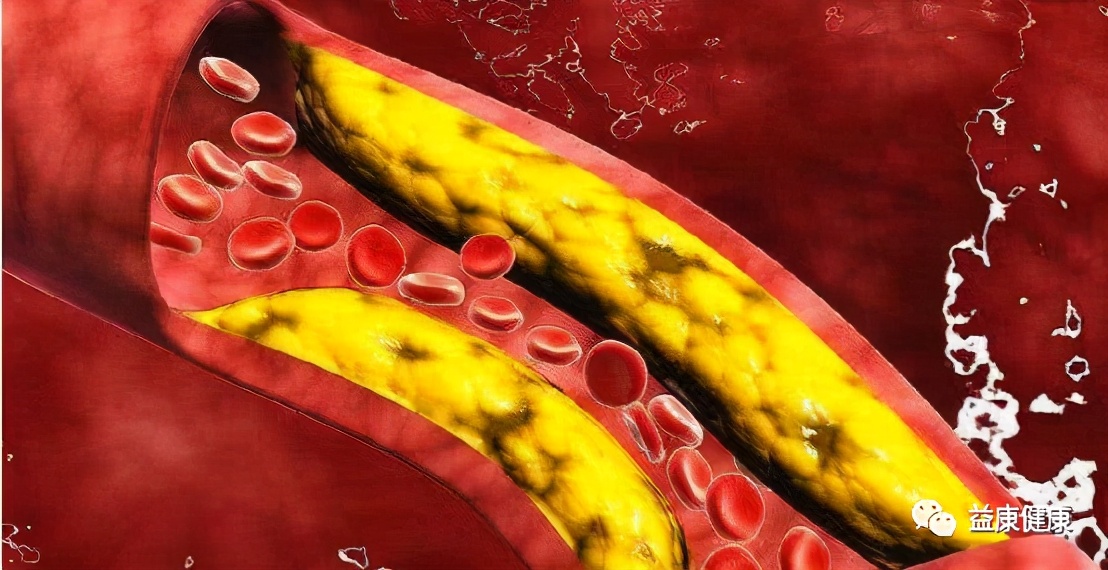 血脂高怎么办,血脂高怎么办吃什么能降脂肪