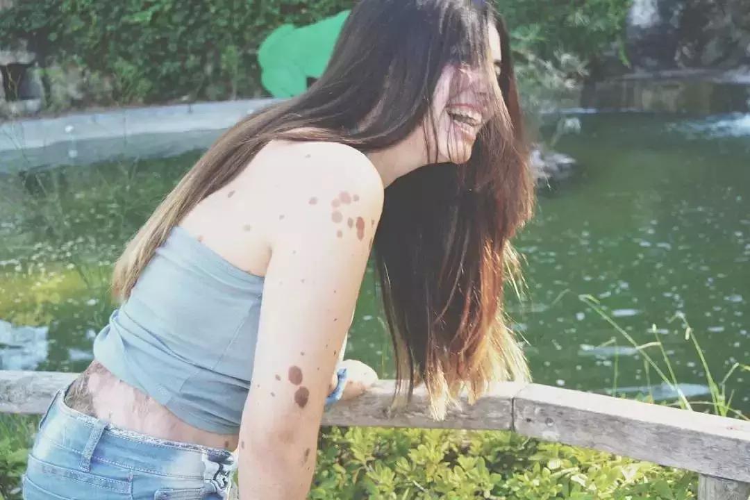 全身黑斑被骂“斑点狗”，身高160的她却成为最美超模…