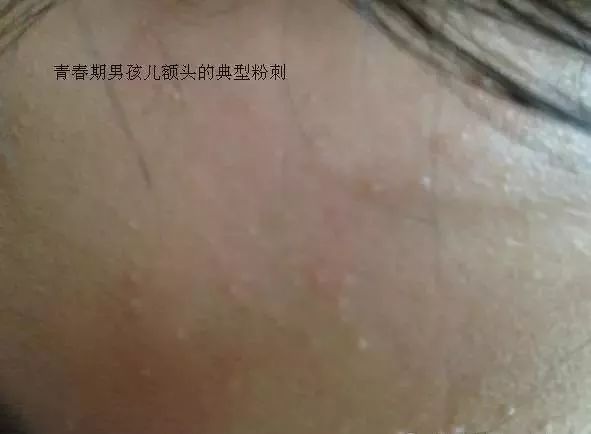 闭合性粉刺的正确消除方法,阿司匹林祛除闭合性粉刺